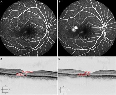 The safe lowest effective power of subthreshold micropulse laser treatment in Chinese patients with acute or chronic central serous chorioretinopathy